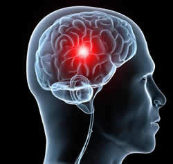 AVC: La stimulation cérébrale pour retrouver la parole et la mémoire